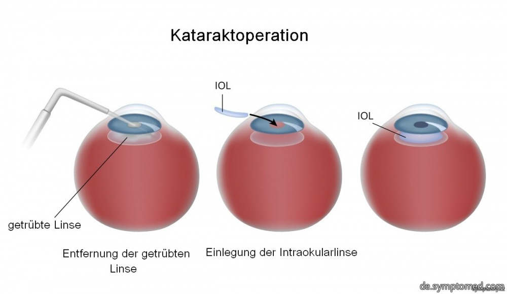 Kataraktoperation