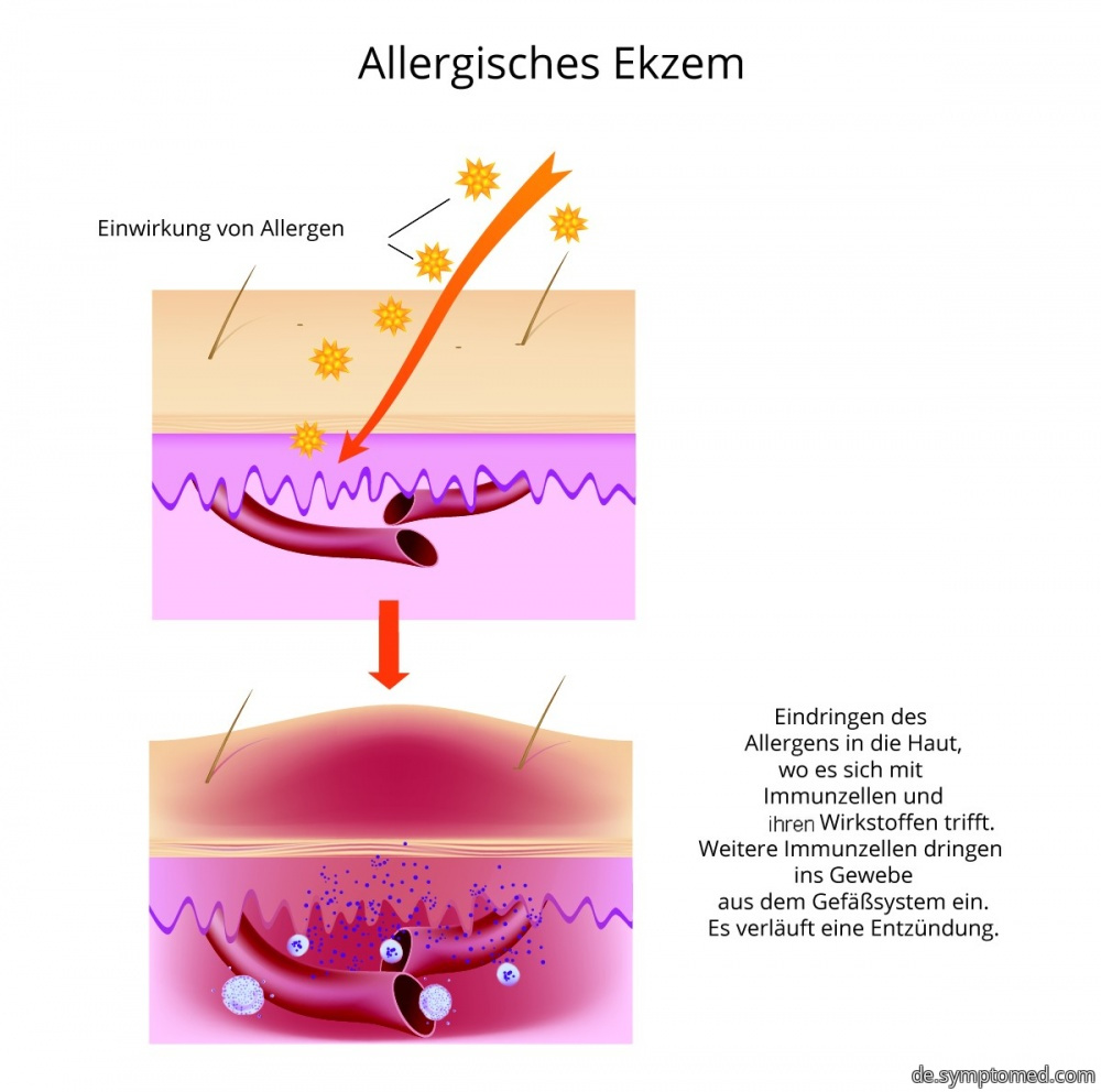 Verlauf der Bildung von allergischem Ekzem