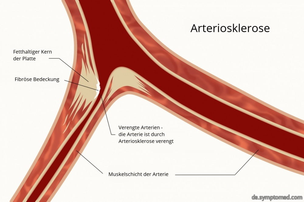 Arteriosklerose - Arterienverkalkung
