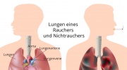 Chronisch obstruktive Lungenerkrankung