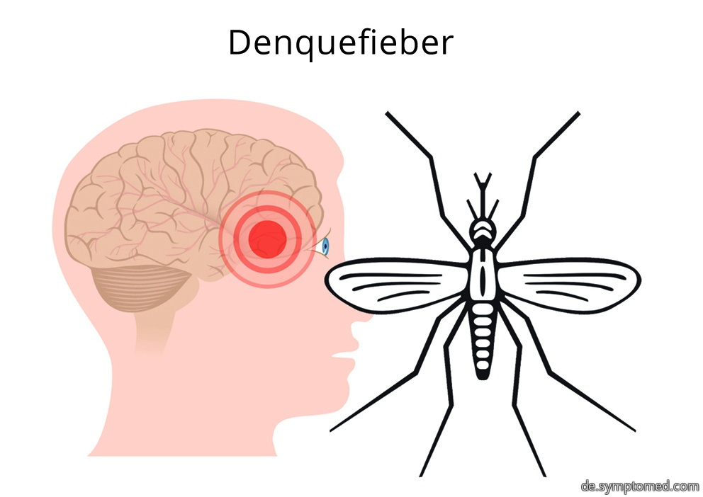 Denguefieber