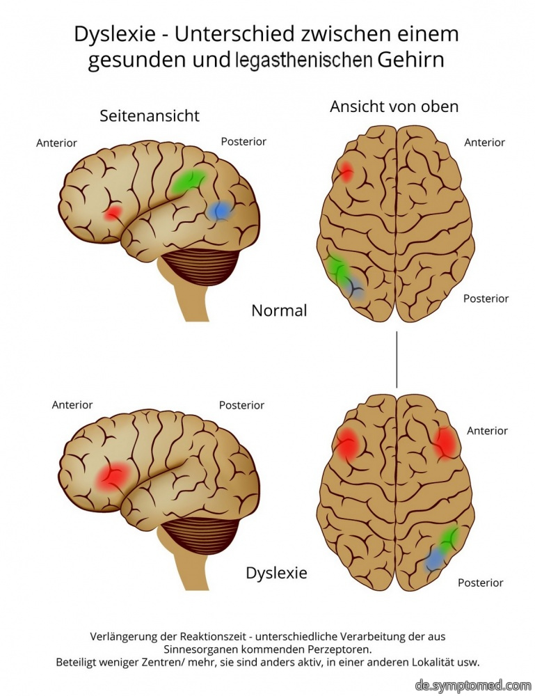 Schematische Darstellung eines von Dyslexie betroffenen Gehirns