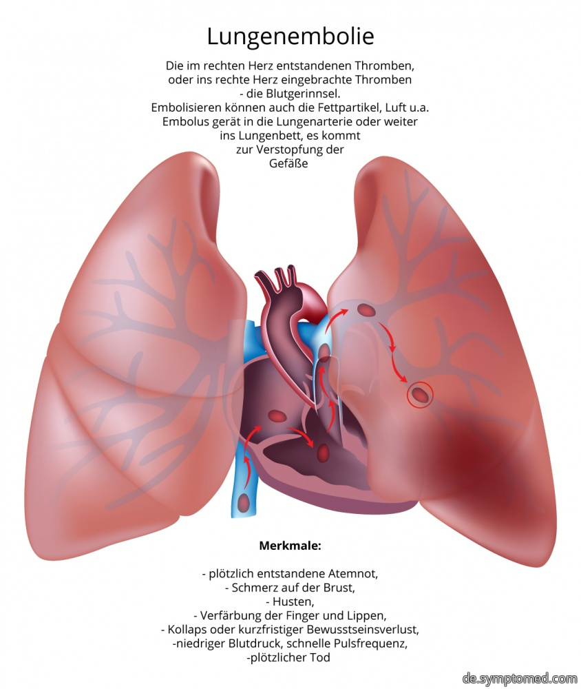 Lungenembolie