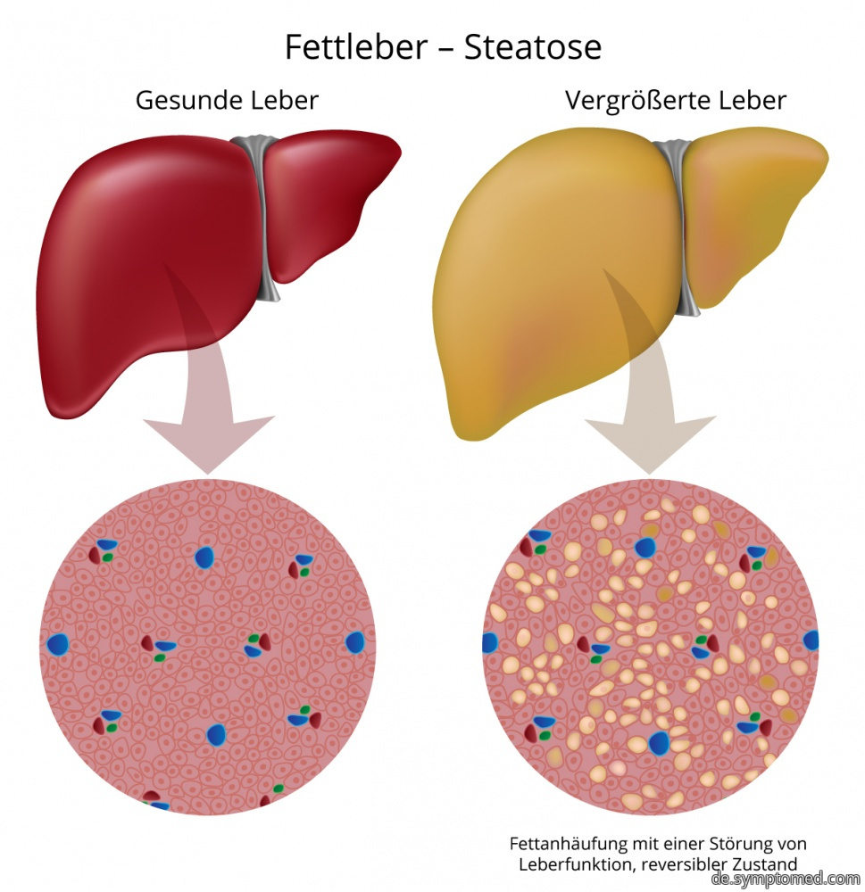 Fettleber - Steatose