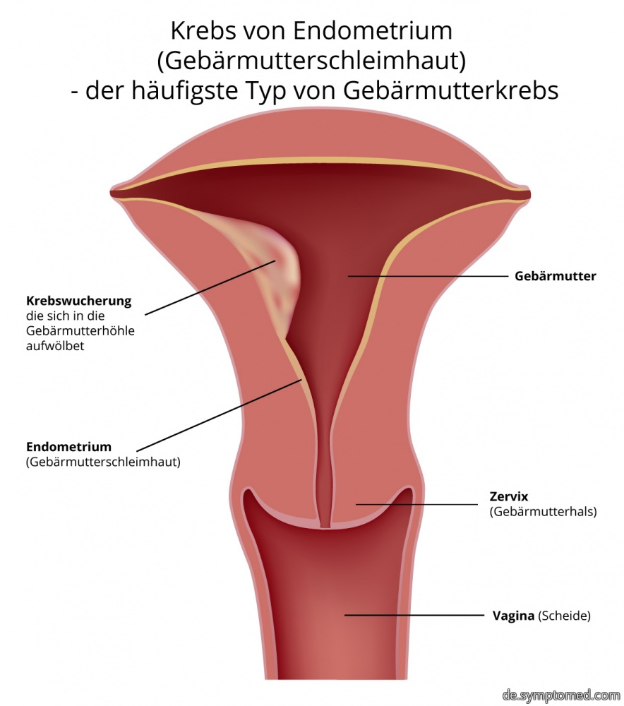 Krebs von Endometrium