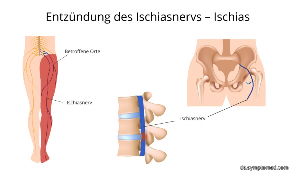 Entzündung des Ischiasnervs - Ischias