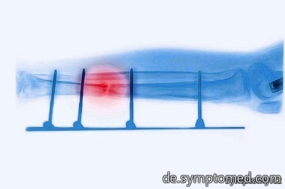 Röntgenbild des gebrochenen Beines