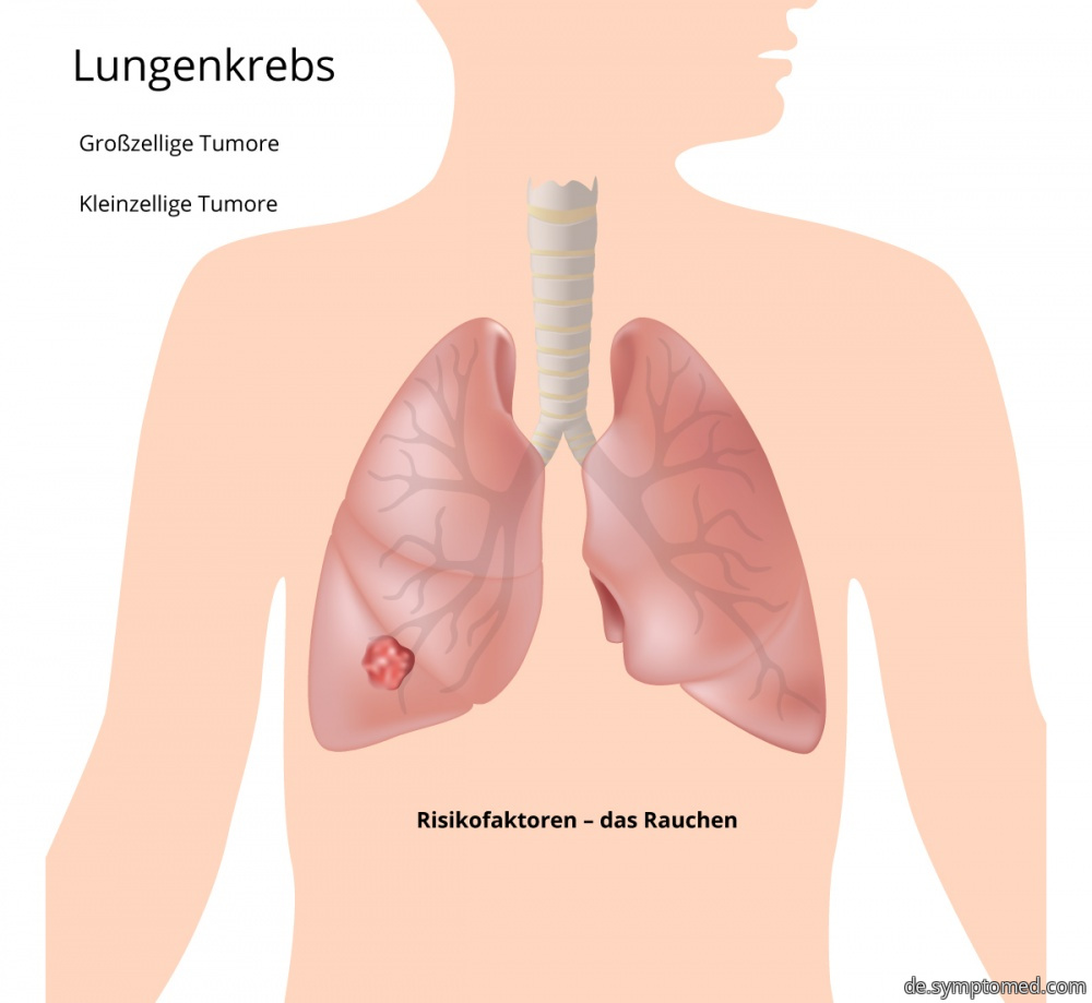 Lungenkrebs