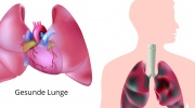 Lungenpest