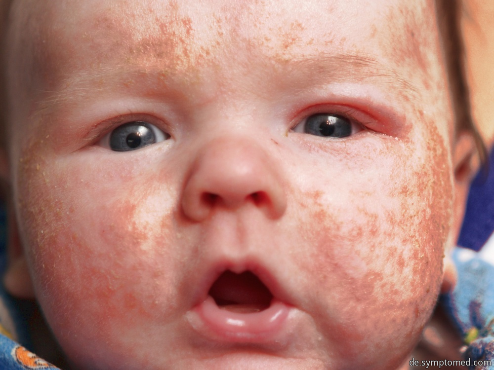 Masern - Ausschlag auf dem Gesicht eines Babys