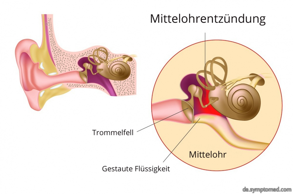 Schematische Darstellung der Mittelohrentzündung