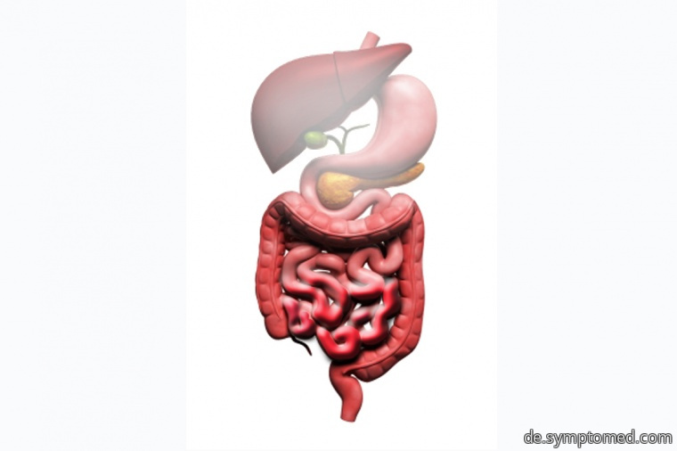 Morbus Crohn - Symptome