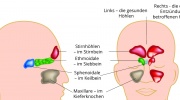 Nasennebenhöhlenentzündung