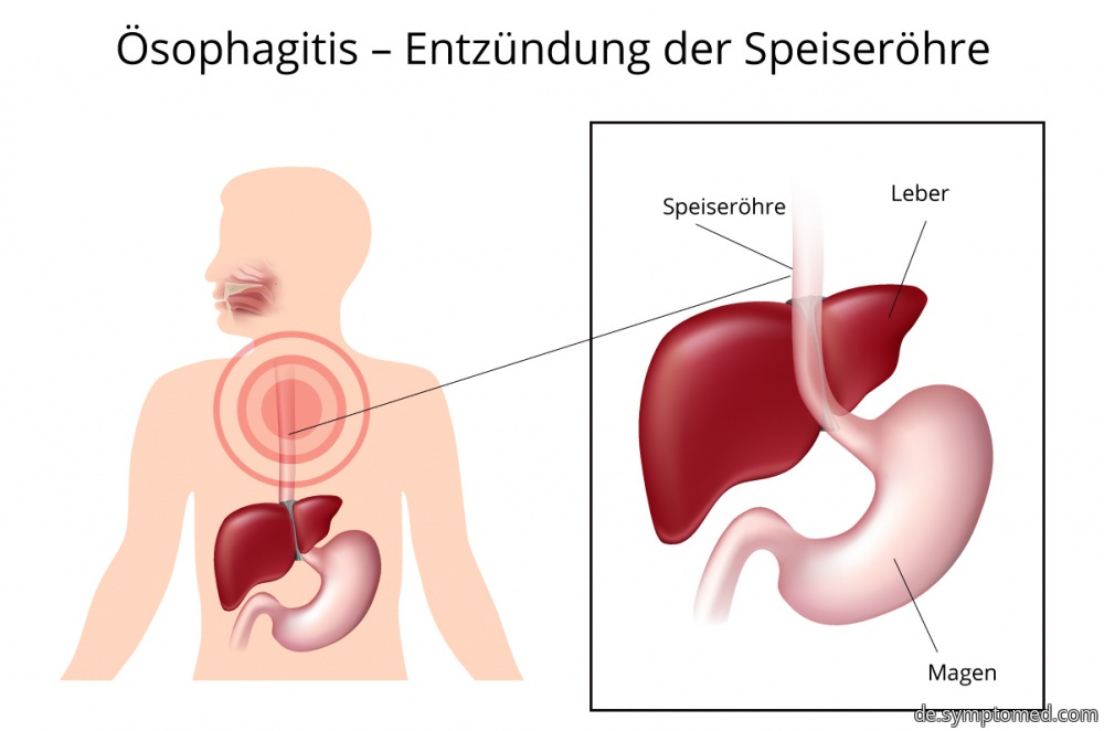 Ösophagitis - Speiseröhrenentzündung