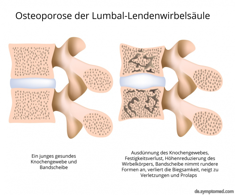 Osteoporose der Lendenwirbelsäule
