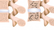 Osteoporose der Lendenwirbelsäule