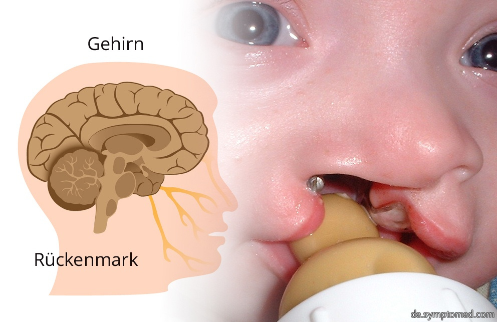 Pätau-Syndrom bei einem Baby