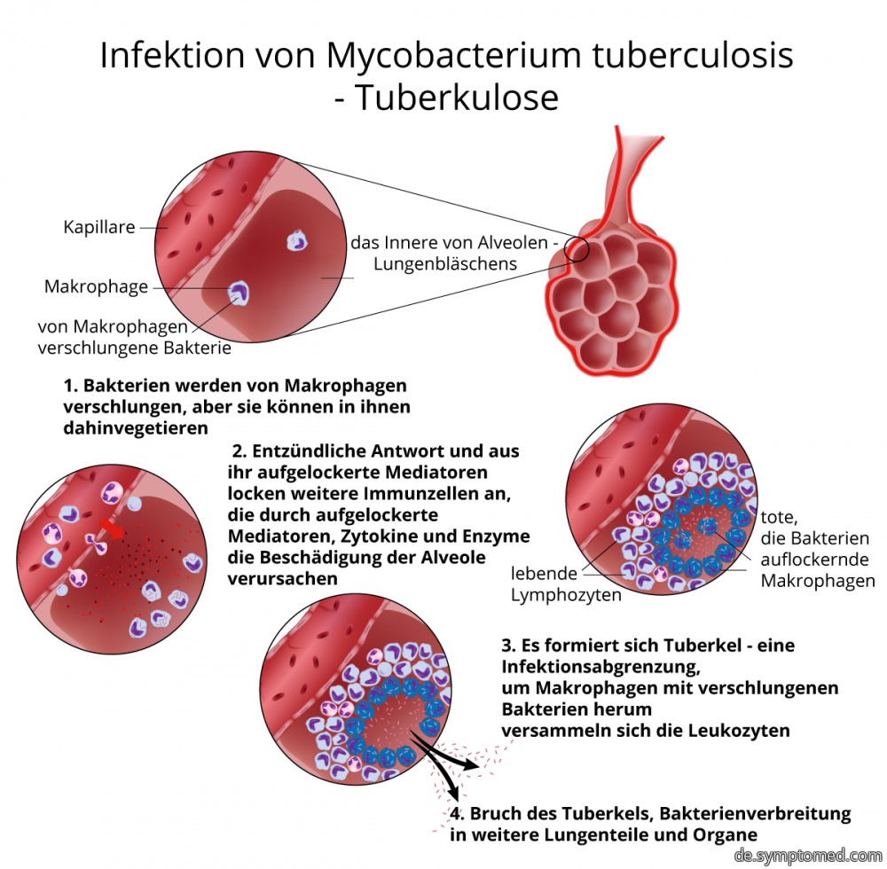 Tuberkulose - Infektion mit Mycobacterium tuberculosis