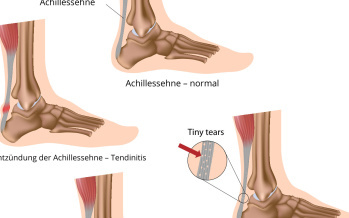 Achillessehne