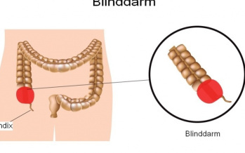 Blinddarm