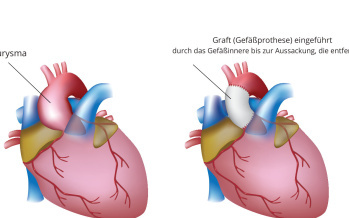 Aneurysma