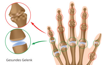 Arthrose der Finger