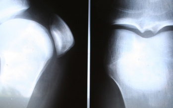 Arthrose