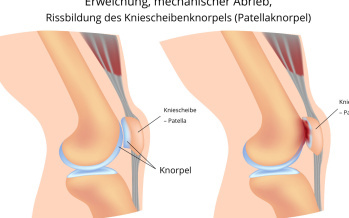 Chondromalazie der Kniescheibe