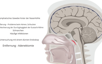 Entfernung von Rachenmandeln - Adenotomie