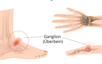 Ganglion