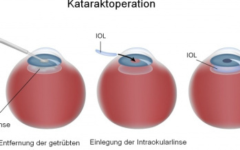 Kataraktoperation