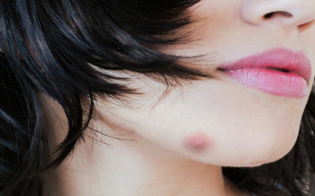 Abszess