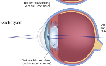Alterssichtigkeit
