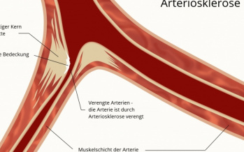 Arteriosklerose