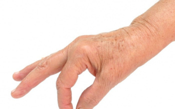 Arthritis