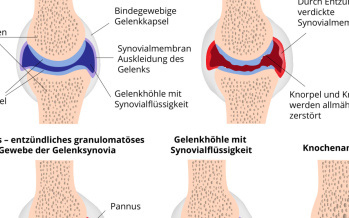 Arthritis