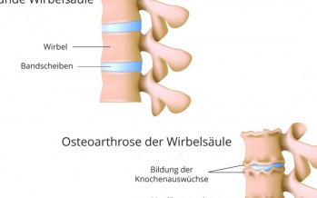 Arthrose der Wirbelsäule