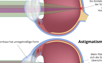 Astigmatismus