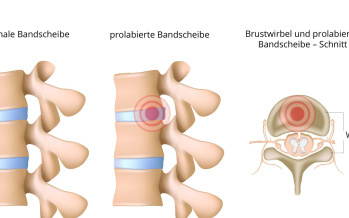 Bandscheibenvorfall