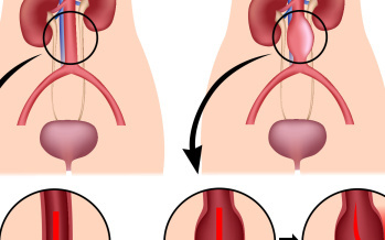 Bauchaortenaneurysma 