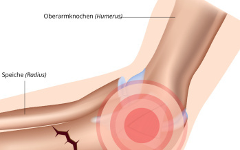 Bruch von Ellbogen und Unterarm