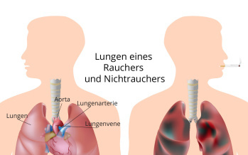 Chronisch obstruktive Lungenerkrankung