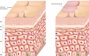 Dermatitis