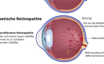 Diabetische Retinopathie