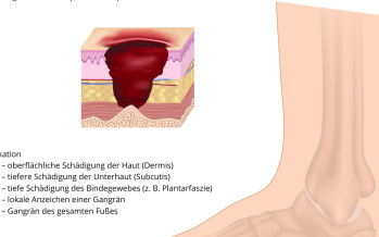 Diabetisches Fußsyndrom