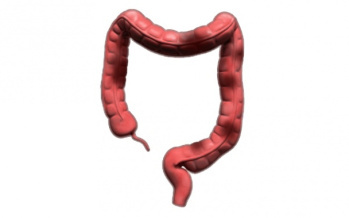 Dickdarmkrebs