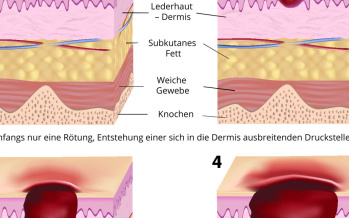 Die Wundliegen