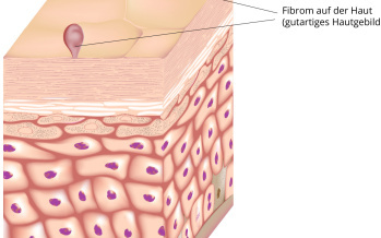 Fibrom