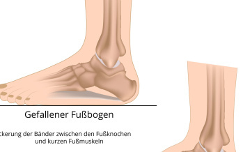 Flache Füße