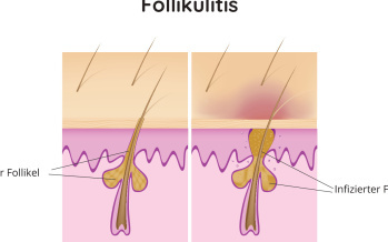 Follikulitis